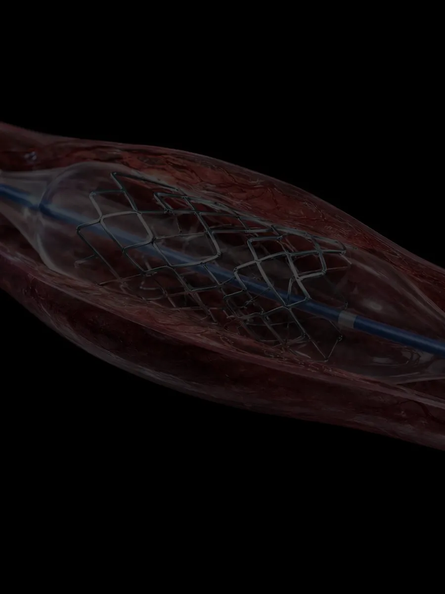 Catheter balloon stent — Life Sciences