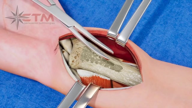 Wrist Surgery Animation -- Medical & Surgical animation
